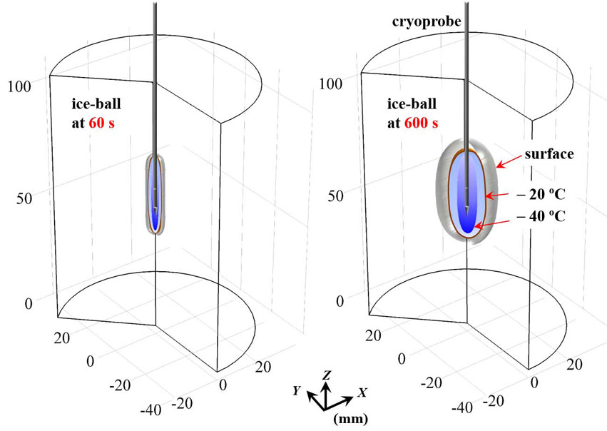 The cooling performance of a cryoprobe: Establishing guidelines for the safety margins in cryosurgery. Advances in Engineering