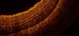 Cross-sectional image of swine coronary artery by micro-OCT - advances in engineering