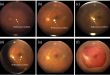 Miniaturized indirect ophthalmoscopy promises an affordable solution to foster smartphone wide-field fundus photography in telemedicine - Advances in Engineering