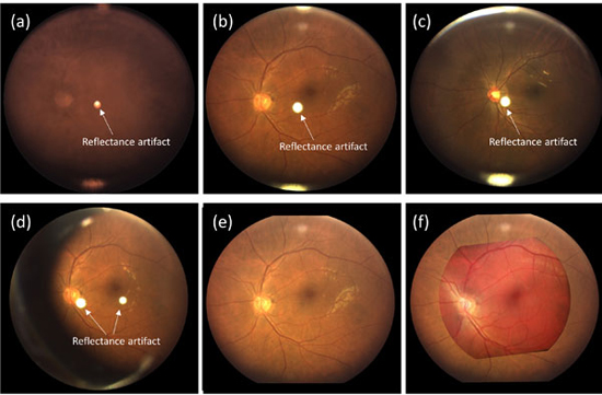 Miniaturized indirect ophthalmoscopy promises an affordable solution to foster smartphone wide-field fundus photography in telemedicine - Advances in Engineering