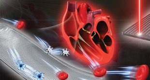 A femtosecond Bessel laser for preparing a nontoxic slippery liquid-infused porous surface (SLIPS) for improving the hemocompatibility of NiTi alloys - Advances in Engineering