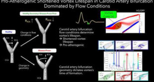 Decoding the Impact of Vortex Dynamics on Carotid Artery Health: Swirling Safeguards Against Atherosclerosis - Advances in Engineering