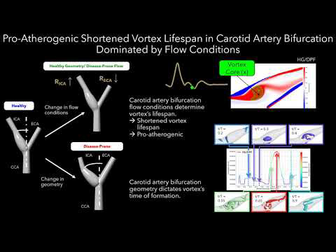 Decoding the Impact of Vortex Dynamics on Carotid Artery Health ...